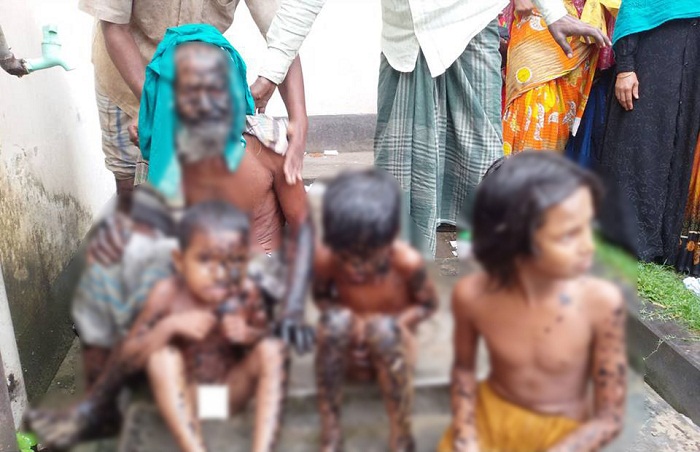 চাঁপাইনবাবগঞ্জে উত্তপ্ত পিচে ঝলসে গেছে বৃদ্ধসহ তিন শিশু